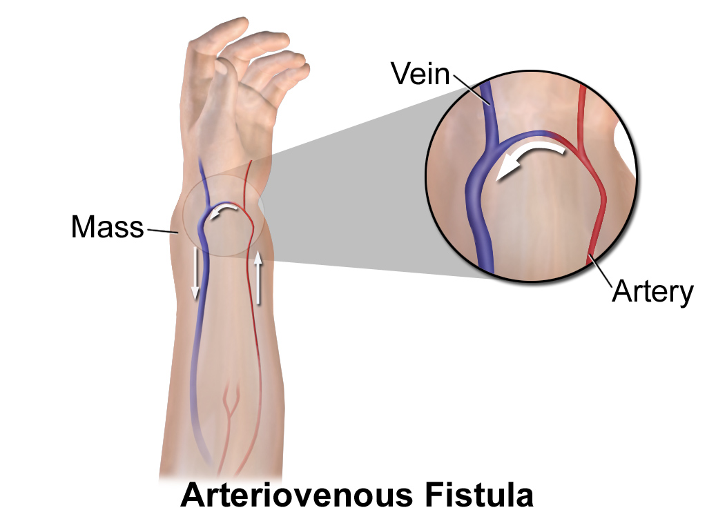 AV Fistula doctor in Ludhiana
